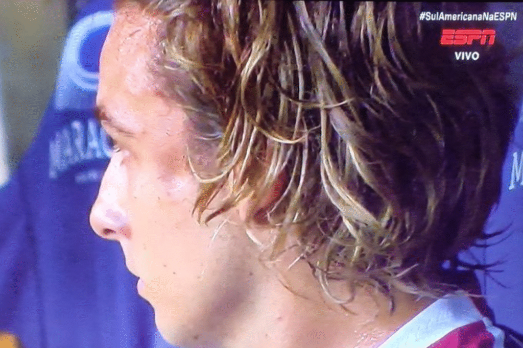 Agustin Canobbio sofre afundamento na face